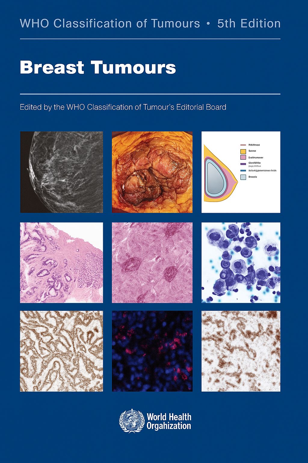 WHO Classification of Tumours: Breast Tumours 5th Edition