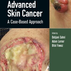 Advanced Skin Cancer 1st Edition