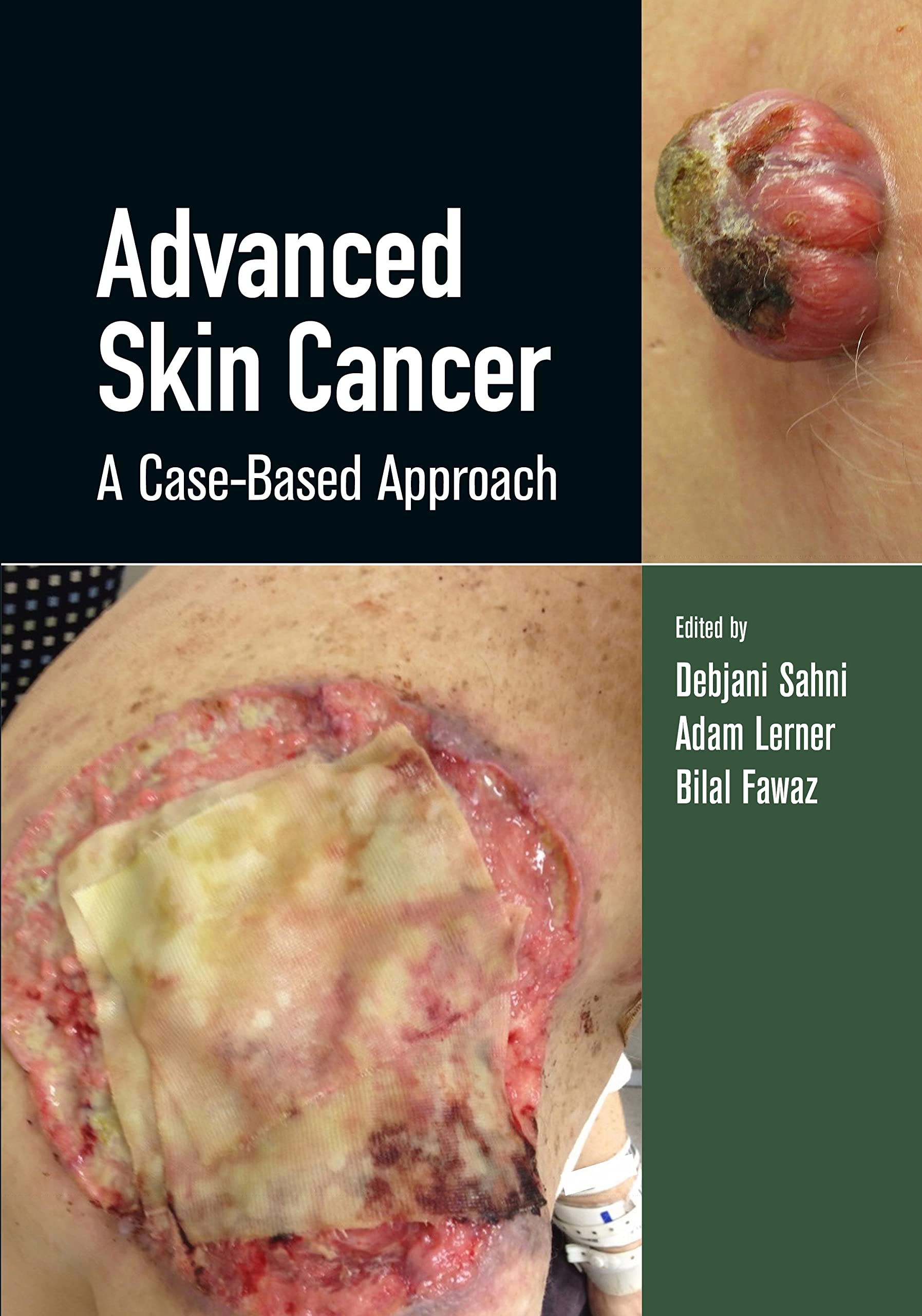Advanced Skin Cancer 1st Edition