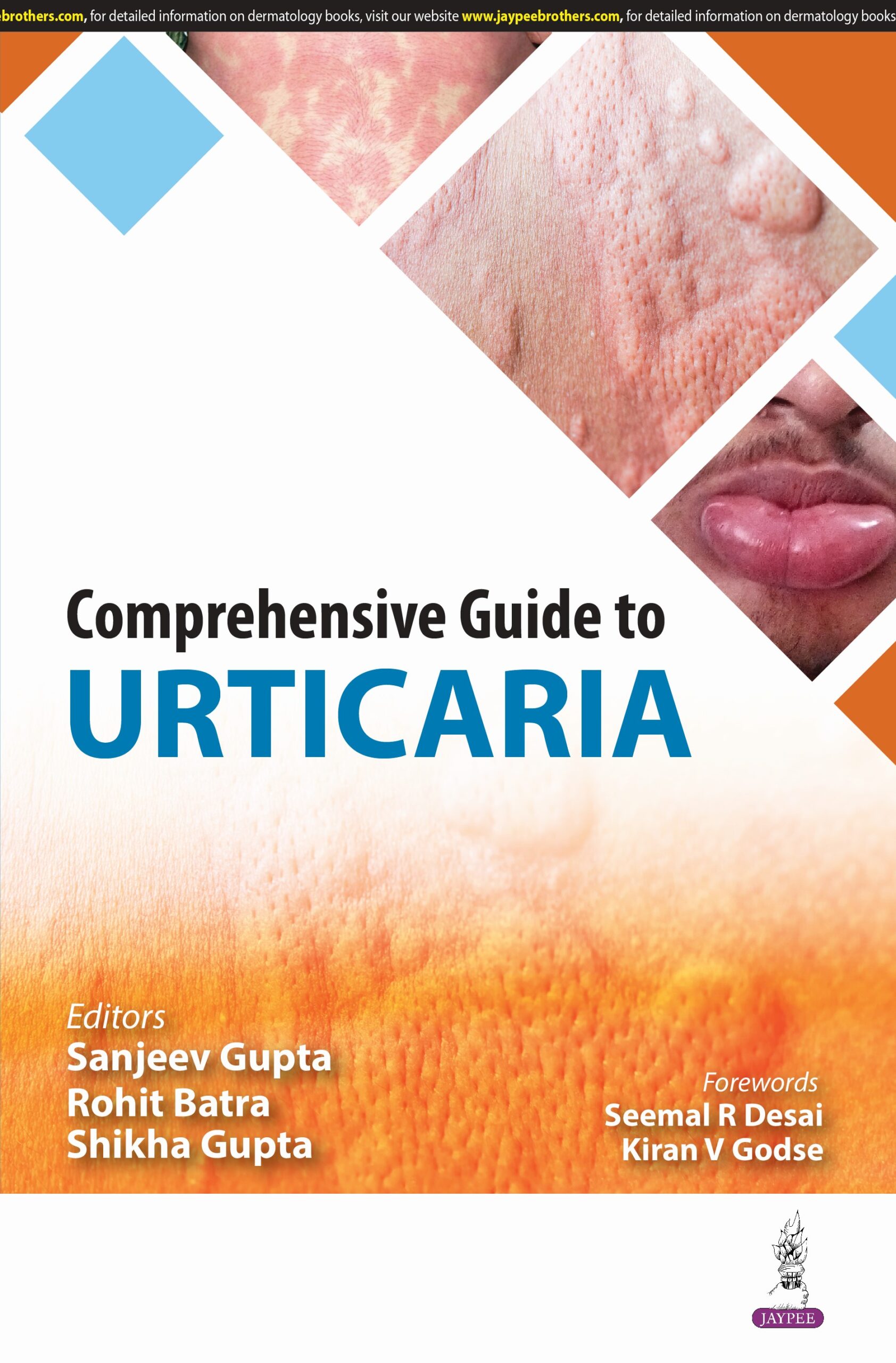 Comprehensive Guide to Urticaria 1st Edition