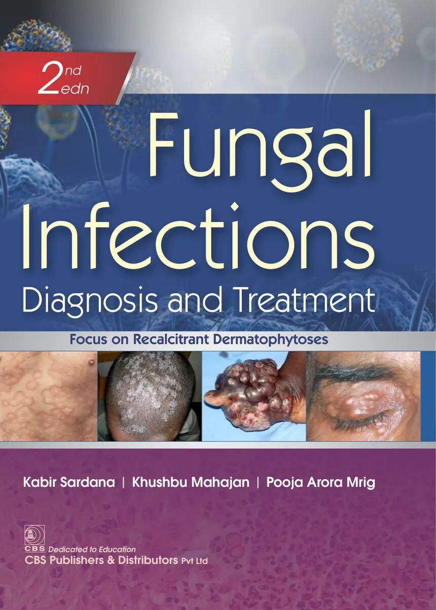 Fungal Infections Diagnosis and Treatment 2nd Edition