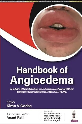 Handbook of Angioedema 1st Edition