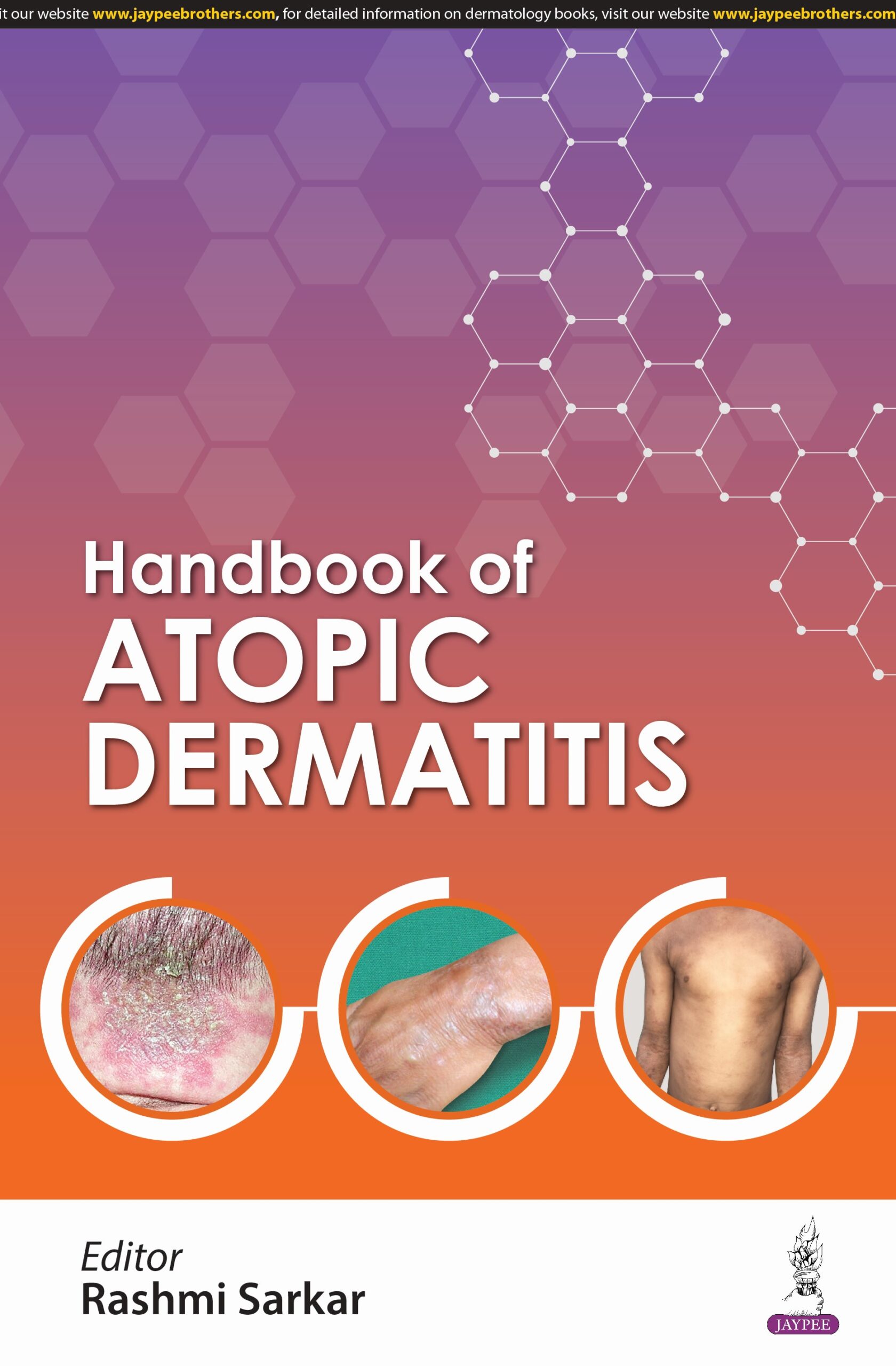 Handbook of Atopic Dermatitis 1st Edition