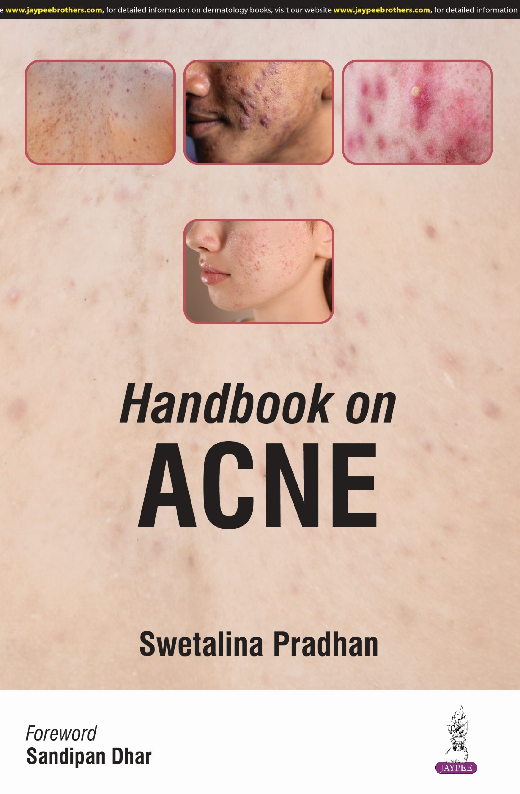 Handbook on Acne 1st Edition