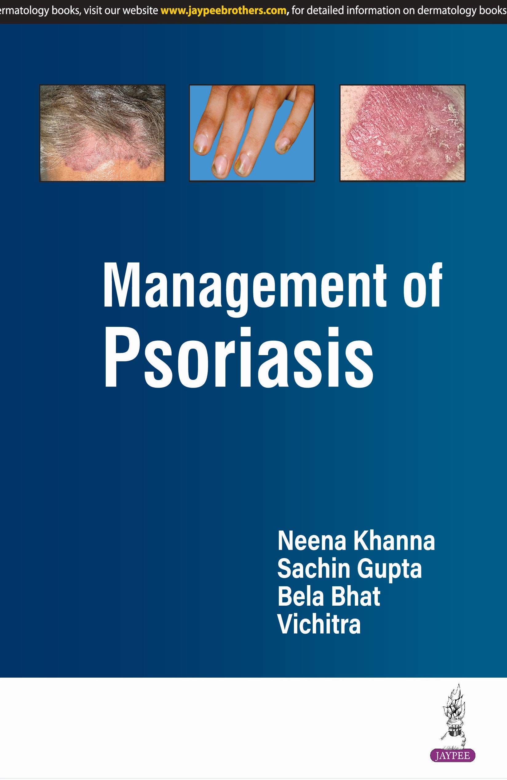 Management of Psoriasis 1st Edition