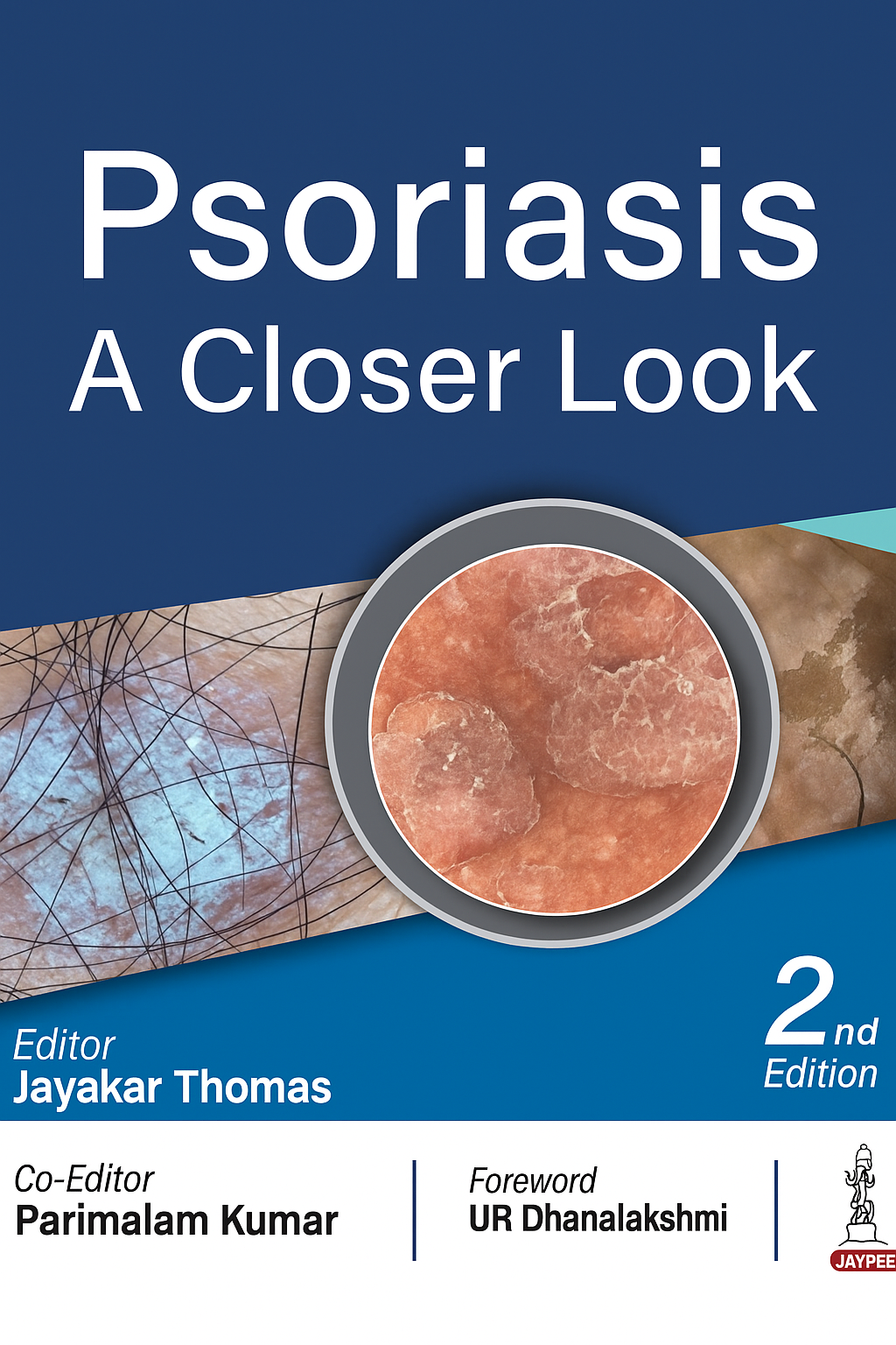 Psoriasis A Closer Look 2nd Edition