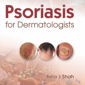 Psoriasis for Dermatologists 1st Edition