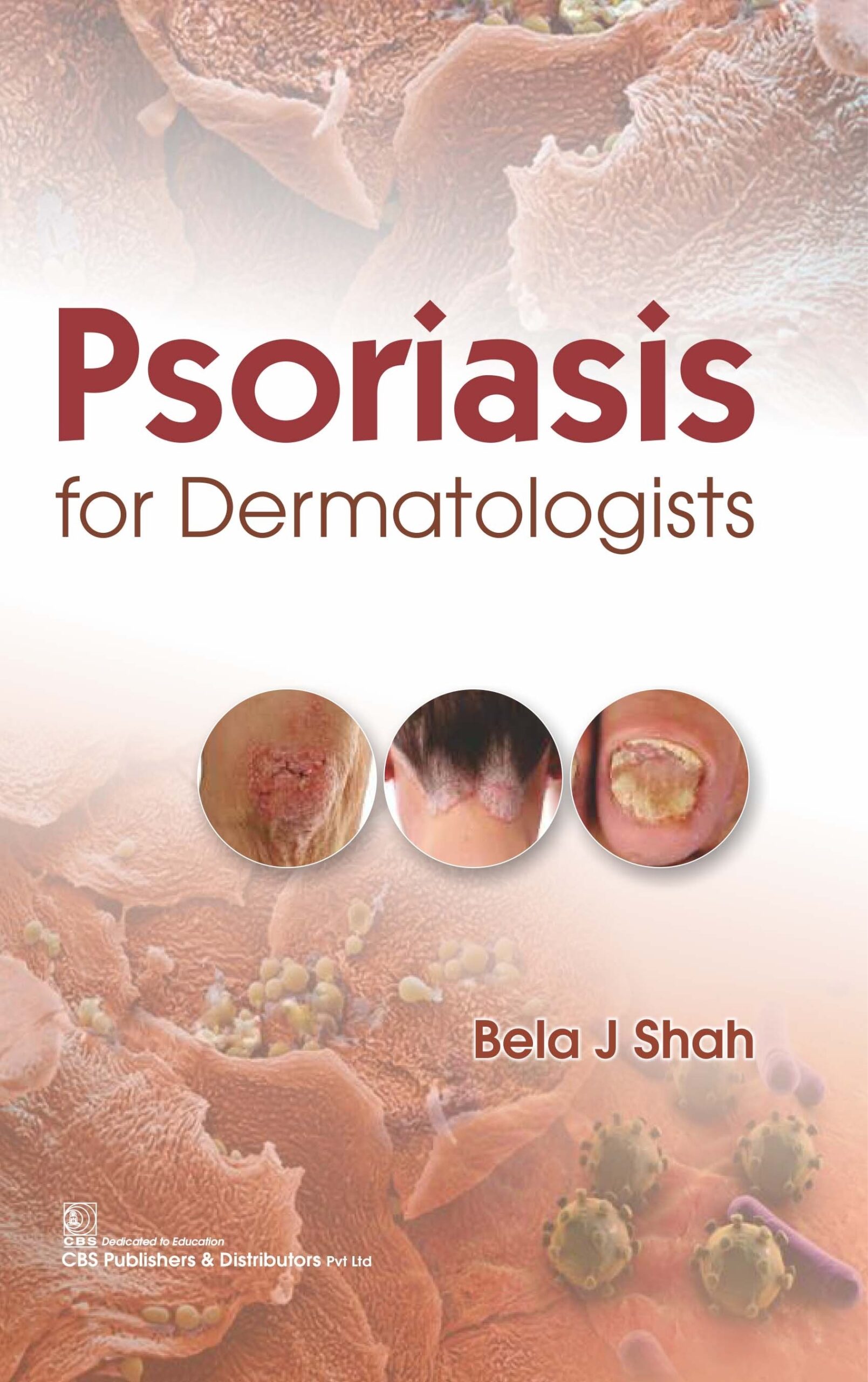 Psoriasis for Dermatologists 1st Edition