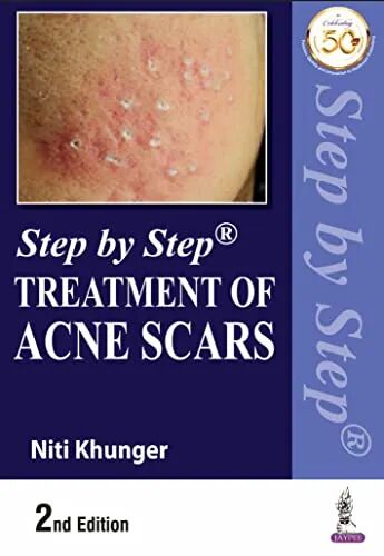 Step by Step Treatment of Acne Scars 2nd Edition